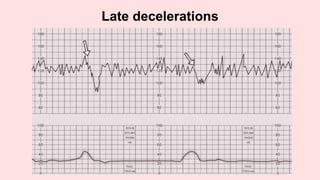 Late decelerations
 