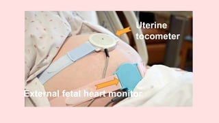 Uterine
tocometer
External fetal heart monitor
 