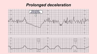 Prolonged deceleration
 
