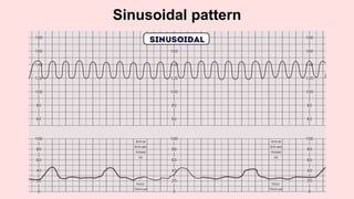 Sinusoidal pattern
 