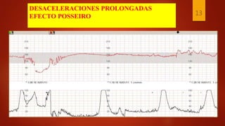 DESACELERACIONES PROLONGADAS
EFECTO POSSEIRO 13
 