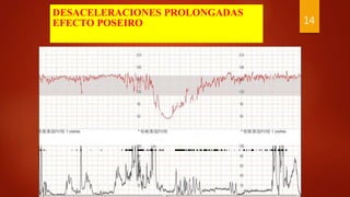 DESACELERACIONES PROLONGADAS
EFECTO POSEIRO 14
 