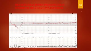 DESACELERACIONES PROLONGADAS
SÍNDROME DE VENA CAVA INFERIOR
20
 