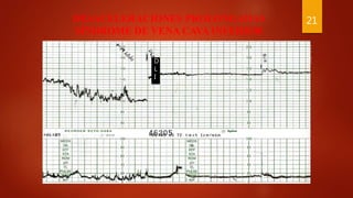 DESACELERACIONES PROLONGADAS
SÍNDROME DE VENA CAVA INFERIOR
21
D
L
I
 