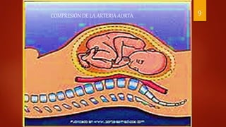 9
COMPRESIÓN DE LA ARTERIA AORTA
 