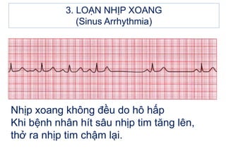 Nhịp xoang không đều do hô hấp
Khi bệnh nhân hít sâu nhịp tim tăng lên,
thở ra nhịp tim chậm lại.
3. LOẠN NHỊP XOANG
(Sinus Arrhythmia)
 