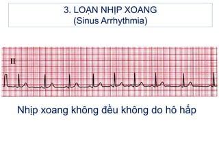 Nhịp xoang không đều không do hô hấp
3. LOẠN NHỊP XOANG
(Sinus Arrhythmia)
 