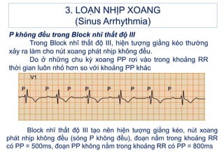 P không đều trong Block nhĩ thất độ III
Trong Block nhĩ thất độ III, hiện tượng giằng kéo thường
xảy ra làm cho nút xoang phát nhịp không đều.
Do ở những chu kỳ xoang PP rơi vào trong khoảng RR
thời gian luôn nhỏ hơn so với khoảng PP khác
Block nhĩ thất độ III tạo nên hiện tượng giằng kéo, nút xoang
phát nhịp không đều (sóng P không đều), đoạn nằm trong khoảng RR
có PP = 500ms, đoạn PP không nằm trong khoảng RR có PP = 800ms
3. LOẠN NHỊP XOANG
(Sinus Arrhythmia)
 