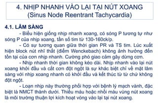 4.1. LÂM SÀNG
- Biểu hiện giống nhịp nhanh xoang, có sóng P tương tự như
sóng P của nhịp xoang, tần số tim từ 130-160ck/p.
- Có sự tương quan giữa thời gian PR và TS tim. Lúc xuất
hiện block nút nhĩ thất (điểm Wenckebach) không ảnh hưởng đến
tồn tại của cơn nhịp nhanh. Cường phó giao cảm gây dừng cơn.
- Nhịp nhanh thời gian không kéo dài. Nhịp nhanh vào lại nút
xoang khởi đầu và cắt cơn đột ngột là sự khác biệt chỉ về mặt lâm
sàng với nhịp xoang nhanh có khởi đầu và kết thúc từ từ chứ không
đột ngột.
- Loạn nhịp này thường phối hợp với bệnh lý mạch vành, đặc
biệt là NMCT thành dưới. Thiếu máu hoặc nhồi máu vùng nút xoang
là môi trường thuận lợi kích hoạt vòng vào lại tại nút xoang.
4. NHỊP NHANH VÀO LẠI TẠI NÚT XOANG
(Sinus Node Reentrant Tachycardia)
 