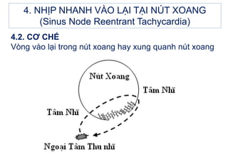 4.2. CƠ CHẾ
Vòng vào lại trong nút xoang hay xung quanh nút xoang
4. NHỊP NHANH VÀO LẠI TẠI NÚT XOANG
(Sinus Node Reentrant Tachycardia)
 