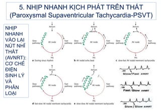 NHỊP
NHANH
VÀO LẠI
NÚT NHĨ
THẤT
(AVNRT):
CƠ CHẾ
ĐIỆN
SINH LÝ
VÀ
PHÂN
LOẠI
5. NHỊP NHANH KỊCH PHÁT TRÊN THẤT
(Paroxysmal Supaventricular Tachycardia-PSVT)
 