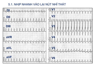 DI
DII
V1
DIII
aVF
aVR
aVL
V2
V3
V4
V6
V5
5.1. NHỊP NHANH VÀO LẠI NÚT NHĨ THẤT
 