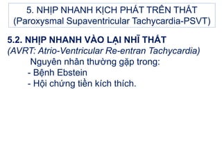 5.2. NHỊP NHANH VÀO LẠI NHĨ THẤT
(AVRT: Atrio-Ventricular Re-entran Tachycardia)
Nguyên nhân thường gặp trong:
- Bệnh Ebstein
- Hội chứng tiền kích thích.
5. NHỊP NHANH KỊCH PHÁT TRÊN THẤT
(Paroxysmal Supaventricular Tachycardia-PSVT)
 