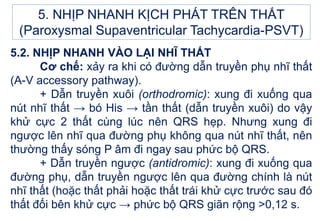 5.2. NHỊP NHANH VÀO LẠI NHĨ THẤT
Cơ chế: xảy ra khi có đường dẫn truyền phụ nhĩ thất
(A-V accessory pathway).
+ Dẫn truyền xuôi (orthodromic): xung đi xuống qua
nút nhĩ thất → bó His → tần thất (dẫn truyền xuôi) do vậy
khử cực 2 thất cùng lúc nên QRS hẹp. Nhưng xung đi
ngược lên nhĩ qua đường phụ không qua nút nhĩ thất, nên
thường thấy sóng P âm đi ngay sau phức bộ QRS.
+ Dẫn truyền ngược (antidromic): xung đi xuống qua
đường phụ, dẫn truyền ngược lên qua đường chính là nút
nhĩ thất (hoặc thất phải hoặc thất trái khử cực trước sau đó
thất đối bên khử cực → phức bộ QRS giãn rộng >0,12 s.
5. NHỊP NHANH KỊCH PHÁT TRÊN THẤT
(Paroxysmal Supaventricular Tachycardia-PSVT)
 