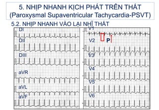 P
5.2. NHỊP NHANH VÀO LẠI NHĨ THẤT
DI
DII
DIII
aVR
aVL
aVF
V1
V2
V3
V4
V5
V6
5. NHỊP NHANH KỊCH PHÁT TRÊN THẤT
(Paroxysmal Supaventricular Tachycardia-PSVT)
 
