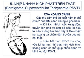 XOA XOANG CẢNH
Các thụ cảm thể áp xuất nằm ở chỗ
chia 2 của ĐM cảnh chung ở góc hàm.
+ Khi kích thích, các xung động
truyền lên não và sau đó các tín hiệu
từ não xuống tim theo dây X làm chậm
nút xoang và chậm dẫn truyền qua nút
nhĩ thất.
+ Hầu hết các PSVT có vòng
vào lại tại nút nhĩ thất nên kích thích
xoang cảnh có thể giúp chẩn đoán và
kết thúc đợt PSVT.
5. NHỊP NHANH KỊCH PHÁT TRÊN THẤT
(Paroxysmal Supaventricular Tachycardia-PSVT)
 