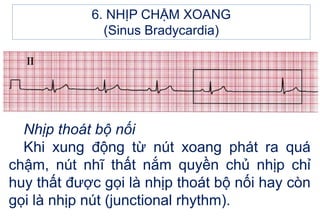 Nhịp thoát bộ nối
Khi xung động từ nút xoang phát ra quá
chậm, nút nhĩ thất nắm quyền chủ nhịp chỉ
huy thất được gọi là nhịp thoát bộ nối hay còn
gọi là nhịp nút (junctional rhythm).
6. NHỊP CHẬM XOANG
(Sinus Bradycardia)
 