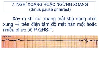 Xảy ra khi nút xoang mất khả năng phát
xung → trên điện tâm đồ mất hẳn một hoặc
nhiều phức bộ P-QRS-T.
7. NGHỈ XOANG HOẶC NGỪNG XOANG
(Sinus pause or arrest)
 