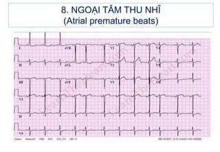 8. NGOẠI TÂM THU NHĨ
(Atrial premature beats)
 