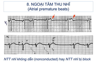 NTT nhĩ không dẫn (nonconducted) hay NTT nhĩ bị block
8. NGOẠI TÂM THU NHĨ
(Atrial premature beats)
 