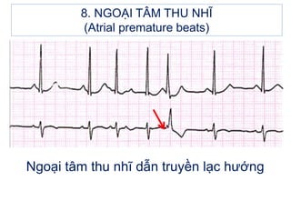 Ngoại tâm thu nhĩ dẫn truyền lạc hướng
8. NGOẠI TÂM THU NHĨ
(Atrial premature beats)
 