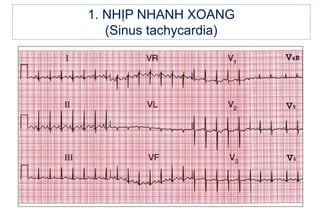 1. NHỊP NHANH XOANG
(Sinus tachycardia)
 