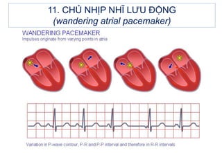 11. CHỦ NHỊP NHĨ LƯU ĐỘNG
(wandering atrial pacemaker)
 
