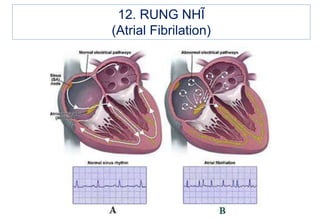 12. RUNG NHĨ
(Atrial Fibrilation)
 
