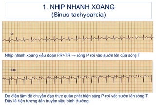 Nhịp nhanh xoang kiểu đoạn PR>TR → sóng P rơi vào sườn lên của sóng T
Đo điện tâm đồ chuyển đạo thực quản phát hiện sóng P rơi vào sườn lên sóng T.
Đây là hiện tượng dẫn truyền siêu bình thường.
1. NHỊP NHANH XOANG
(Sinus tachycardia)
 