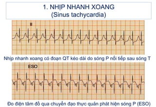 Nhịp nhanh xoang có đoạn QT kéo dài do sóng P nối tiếp sau sóng T
Đo điện tâm đồ qua chuyển đạo thực quản phát hiện sóng P (ESO)
1. NHỊP NHANH XOANG
(Sinus tachycardia)
 