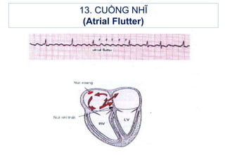 13. CUỒNG NHĨ
(Atrial Flutter)
 