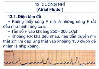 13.1. Điện tâm đồ
+ Không thấy sóng P mà là những sóng F rất
đều như hình răng cưa.
+ Tần số F vào khoảng 250 - 300 ck/ph.
+ Khoảng RR khá đều nhau, nếu dẫn truyền nhĩ
thất 2:1 thì đáp ứng thất vào khoảng 150 ck/ph dễ
nhầm là nhịp xoang.
13. CUỒNG NHĨ
(Atrial Flutter)
 