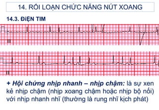 + Hội chứng nhịp nhanh – nhịp chậm: là sự xen
kẻ nhịp chậm (nhịp xoang chậm hoặc nhịp bộ nối)
với nhịp nhanh nhĩ (thường là rung nhĩ kịch phát)
14.3. ĐiỆN TIM
14. RỐI LOẠN CHỨC NĂNG NÚT XOANG
 