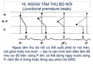 Ngoại tâm thu bộ nối có thể xuất phát từ nút trên,
nút giữa hoặc nút dưới → tạo ra các hình ảnh điện tâm đồ
như sơ đồ trên: sóng P âm, có thể đứng ngay trước sóng
P, nằm lẫn ở trong hoặc đúng sau phức bộ QRS.
16. NGOẠI TÂM THU BỘ NỐI
(Junctional premature beats)
 
