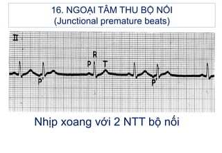 Nhịp xoang với 2 NTT bộ nối
16. NGOẠI TÂM THU BỘ NỐI
(Junctional premature beats)
 