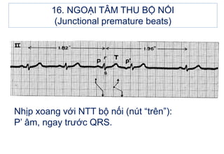 Nhịp xoang với NTT bộ nối (nút “trên”):
P’ âm, ngay trước QRS.
16. NGOẠI TÂM THU BỘ NỐI
(Junctional premature beats)
 