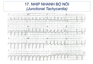 17. NHỊP NHANH BỘ NỐI
(Junctional Tachycardia)
 