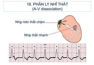 Nhịp trên thất chậm
Nhịp thất nhanh
18. PHÂN LY NHĨ THẤT
(A-V dissociation)
 