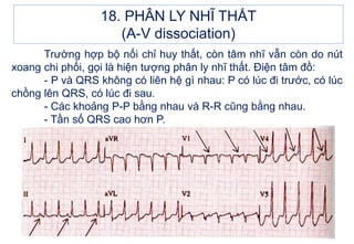 Trường hợp bộ nối chỉ huy thất, còn tâm nhĩ vẫn còn do nút
xoang chi phối, gọi là hiện tượng phân ly nhĩ thất. Điện tâm đồ:
- P và QRS không có liên hệ gì nhau: P có lúc đi trước, có lúc
chồng lên QRS, có lúc đi sau.
- Các khoảng P-P bằng nhau và R-R cũng bằng nhau.
- Tần số QRS cao hơn P.
18. PHÂN LY NHĨ THẤT
(A-V dissociation)
 