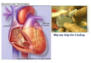 Máy tạo nhịp tim 3 buồng
 