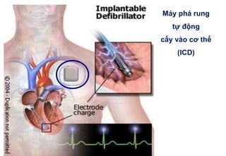 Máy phá rung
tự động
cấy vào cơ thể
(ICD)
 