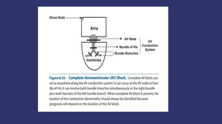 ATRIOVENTRICULAR BLOCKS.pptx
