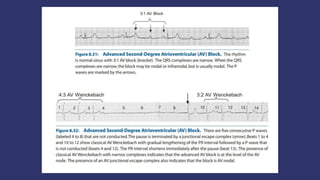 ATRIOVENTRICULAR BLOCKS.pptx
