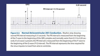 ATRIOVENTRICULAR BLOCKS.pptx