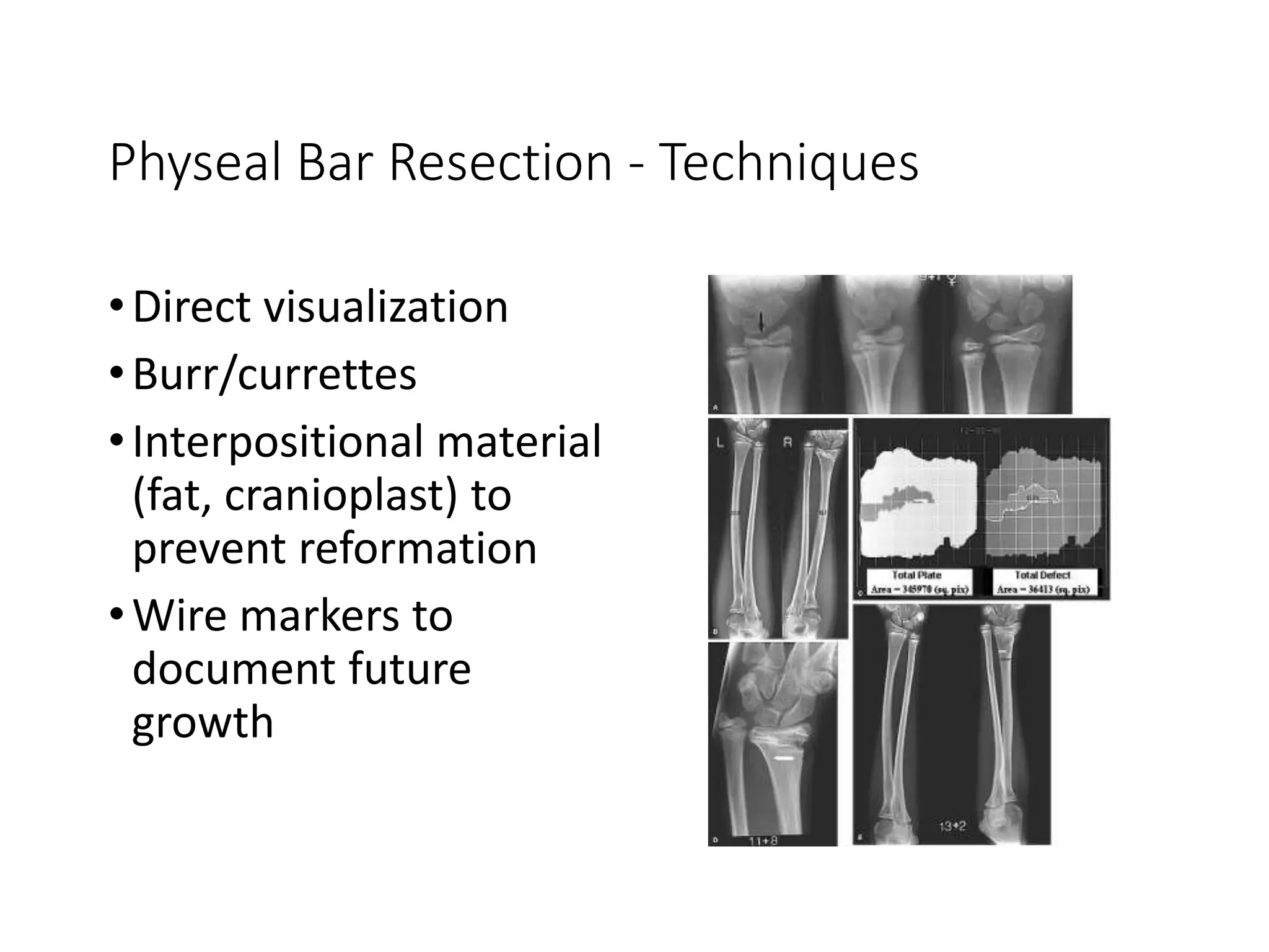 Bar Resection Fractures in children | PPT