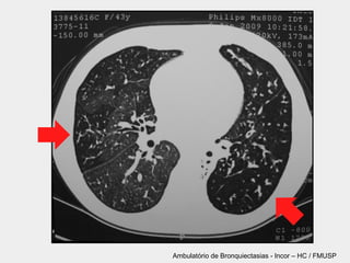 Ambulatório de Bronquiectasias - Incor – HC / FMUSP
 