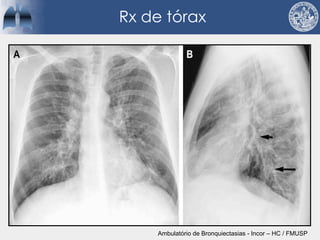 Rx de tórax
Ambulatório de Bronquiectasias - Incor – HC / FMUSP
 
