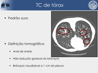 TC de tórax
§ Padrão ouro
§ Definição tomográfica
§ Anel de sinete
§ Não redução gradual do brônquio
§ Brônquio visualizável a 1 cm da pleura
 