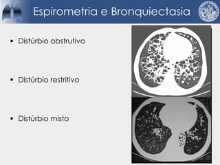 Espirometria e Bronquiectasia
§ Distúrbio obstrutivo
§ Distúrbio restritivo
§ Distúrbio misto
 