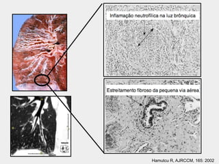 Hamutcu R, AJRCCM, 165: 2002
 